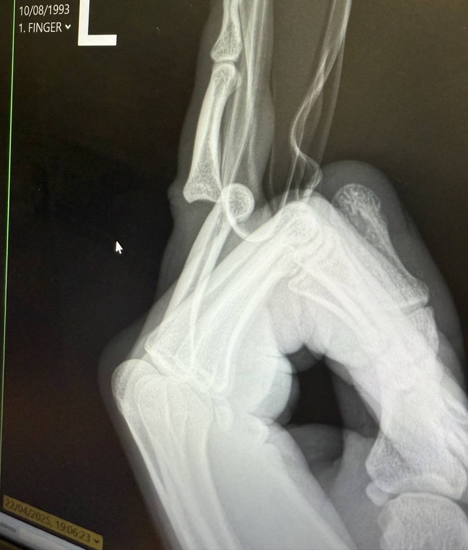 An X-ray of my hand. The finger is quite badly dislocated.